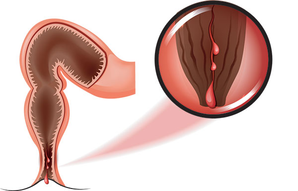 Fissure anale Lyon - ICDO - Fistule et chirurgie digestive