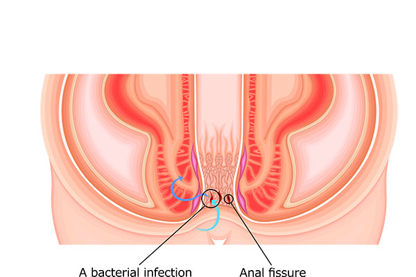 Fissure anale Lyon - ICDO - Fistule et chirurgie digestive