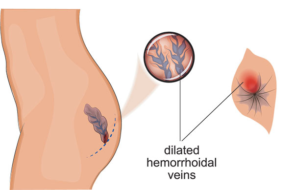 Hemorroïdes Lyon - ICDO - Chirurgie digestive et viscérale