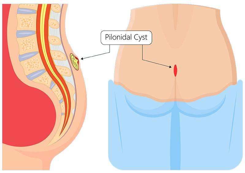 Kyste sacro-coccygien ou sinus pilonidal Lyon - ICDO