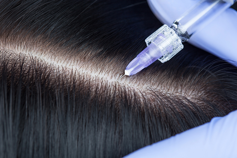 mesotherapie_cheveux