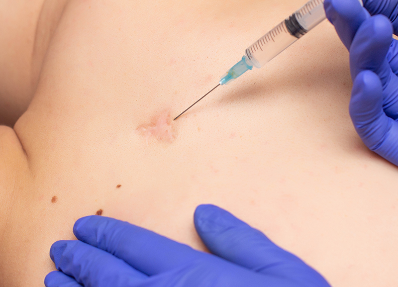 mesotherapie_cicatrice