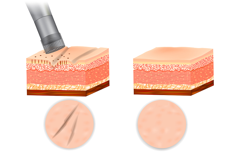 mesotherapie_technique